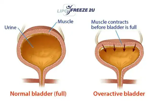 diagram of overactive bladder treatment Rayleigh