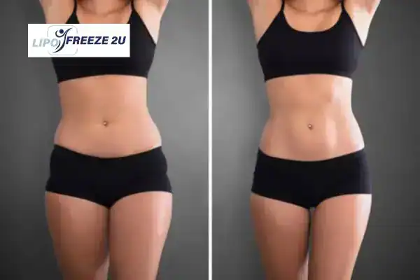 How Can LIPO FREEZE 2U Support Your Post-Pregnancy Body Recovery Rayleigh?