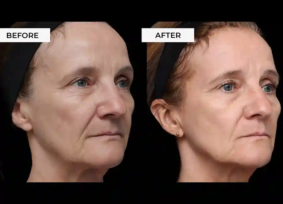 How Many RF Microneedling Sessions Will You Need to See a Difference Rayleigh?