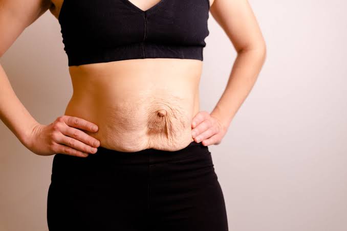Is Surgery Really the Only Way to Repair Diastasis Recti Rayleigh?