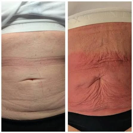 How Does RF Microneedling Improve Crepey, Thin and Uneven Skin Texture Rayleigh?