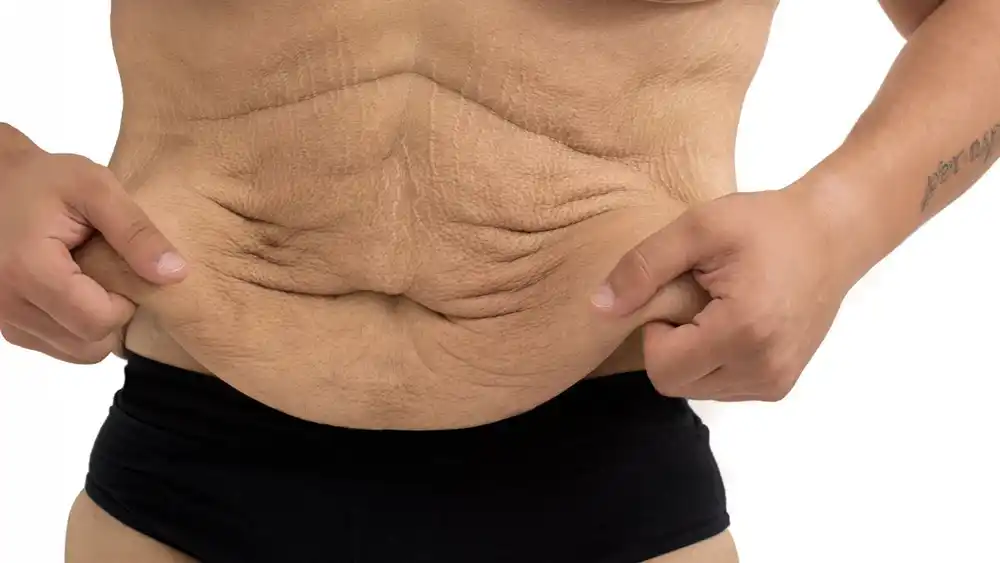 Why Does Weight Loss Medication Leave Some People With Loose or Sagging Skin Rayleigh?